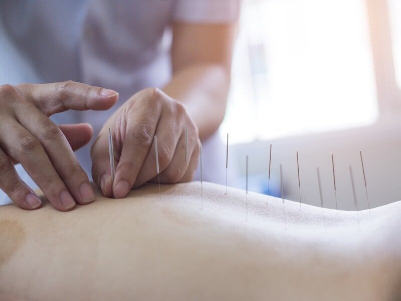 Does Acupuncture Help Peripheral Neuropathy? Viasox