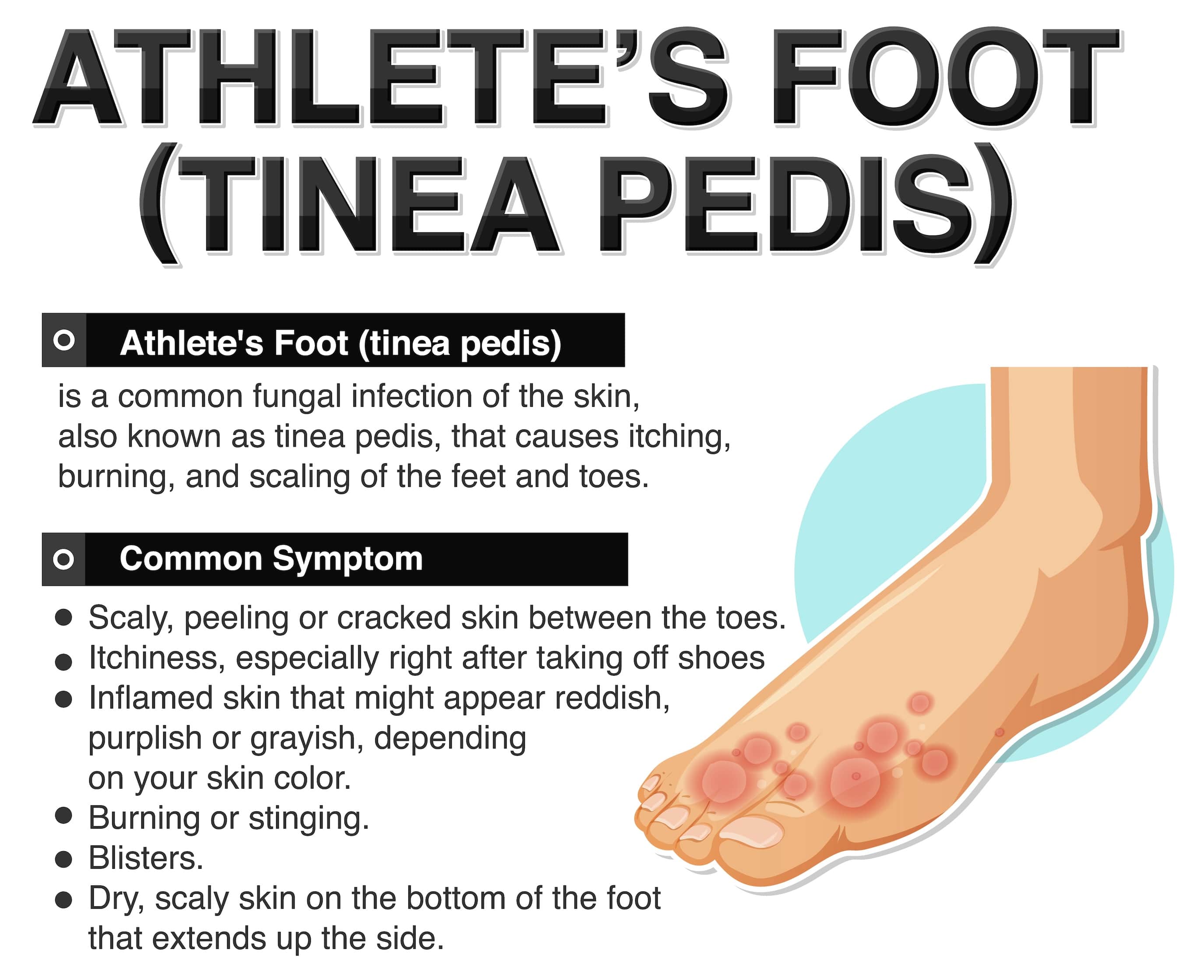 Athlete's foot tinea pedis and Diabetes   Viasox